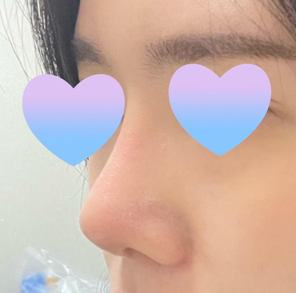 코수술 왜 오래 고민했나 싶네요ㅎ.ㅎ