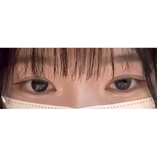 눈매교정 2개월 너무 만족해용~~