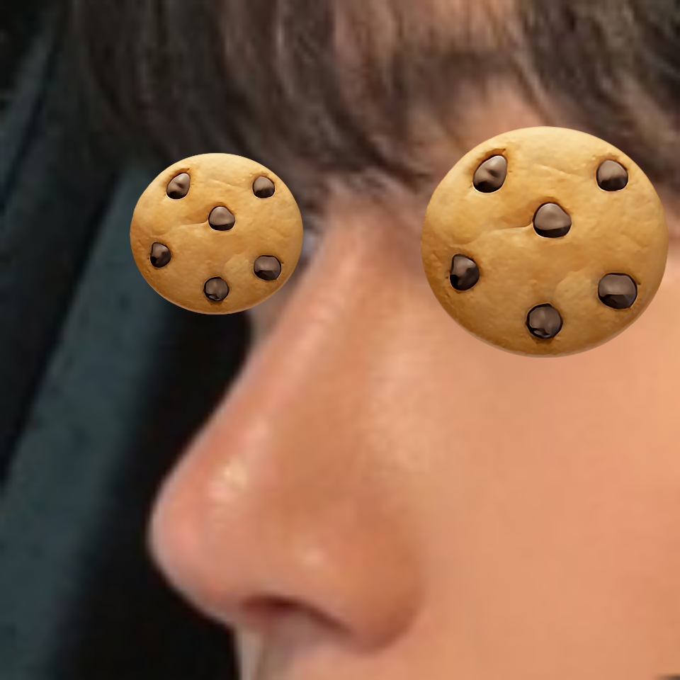 코수술 1000% 만족하고 있습니다 ㅎㅎ