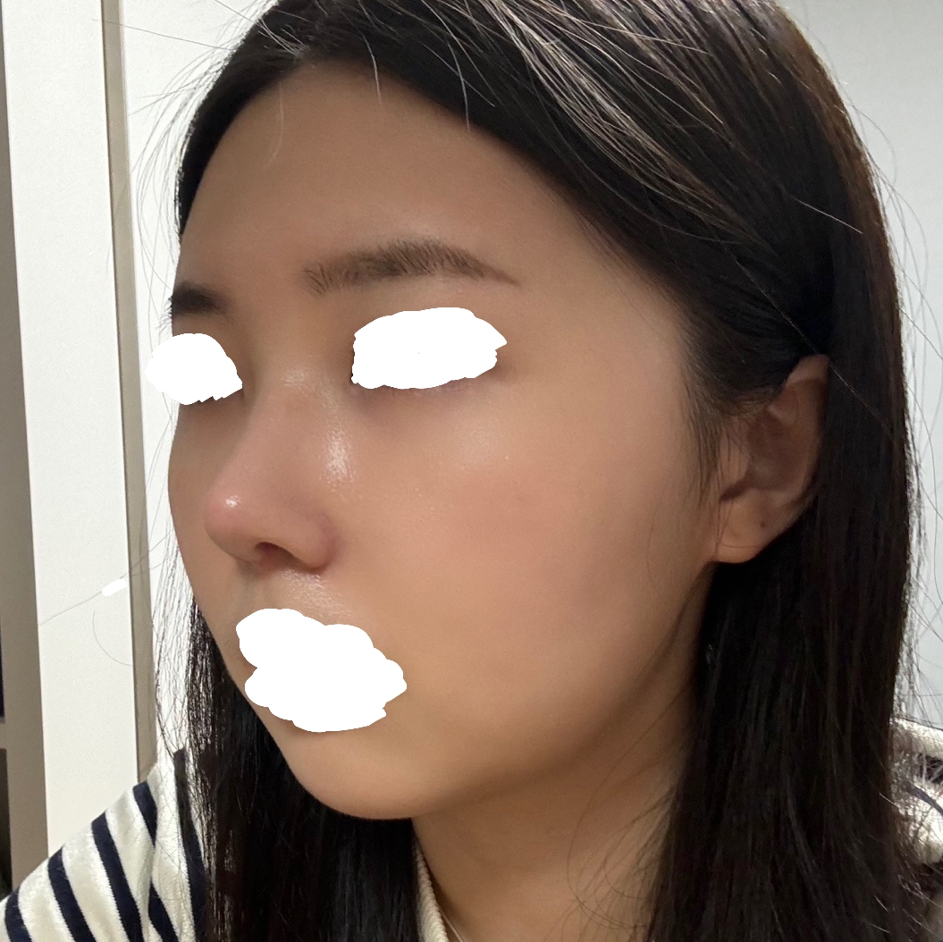 코수술,지방이식 후 옆모습이 너무 예뻐져서 좋아요!