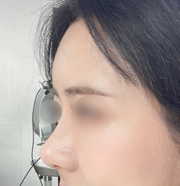 주변에서 어디서했녜요 ㅎㅎ(코, 지방이식3주차!)