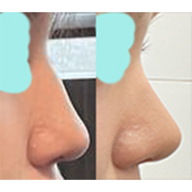 매부리코수술 후기 써봅니당~