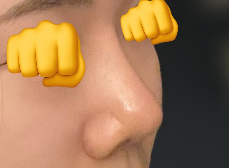 복코성형 1개월차후기에용