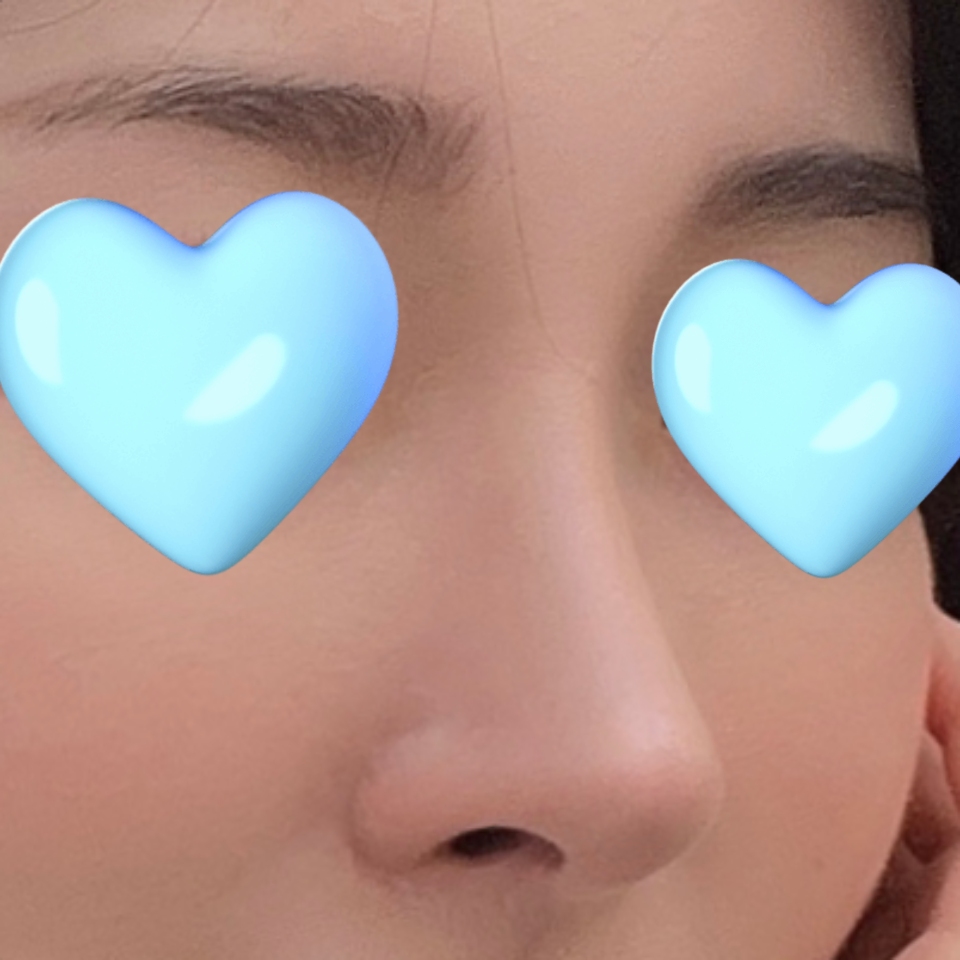 코수술 대성공이에요