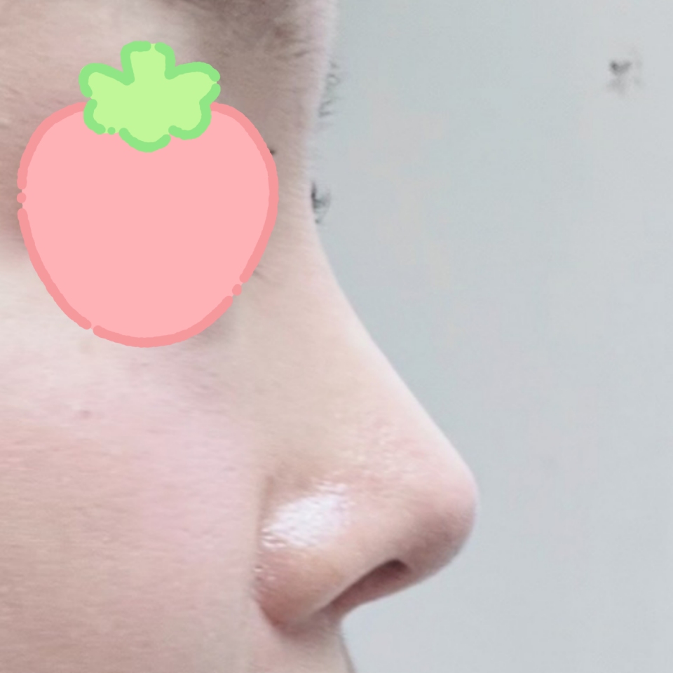 코성형 성공적입니당 !