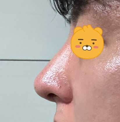 매부리코 무보형물 3개월차 후기