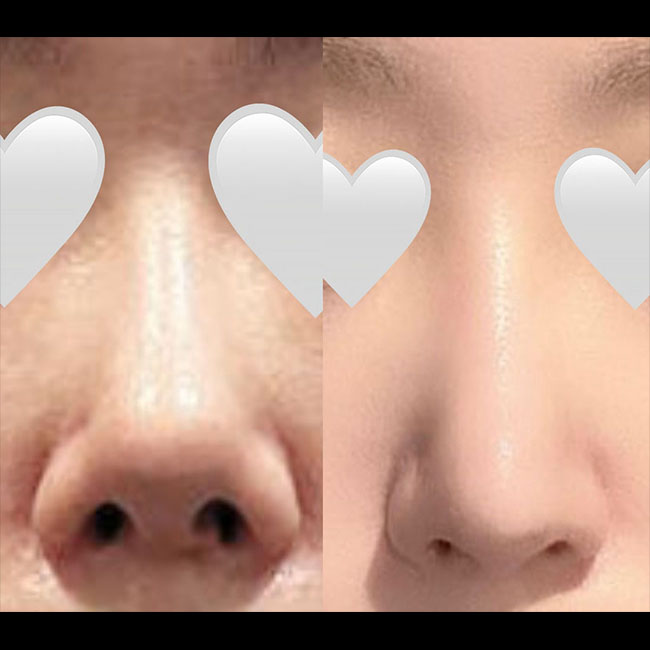 코재수술 성공적굿굿