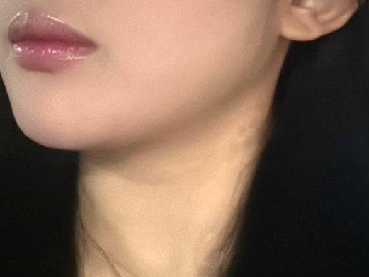 이중턱 지방흡입으로 바이브 선택하길 잘했어용