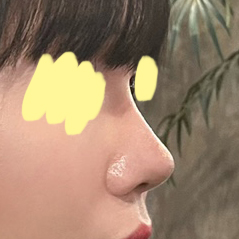 이마거상+쌍꺼풀재수술+복코