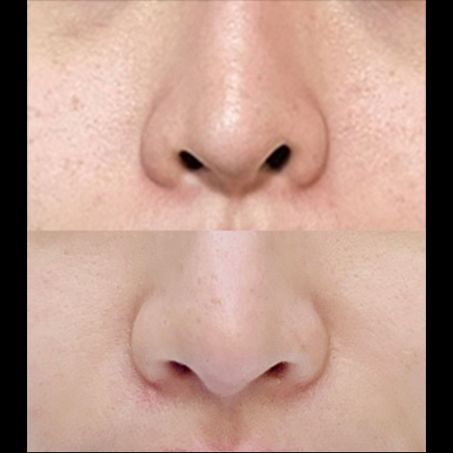 용코교정(비공내리기)재수술 후 비대칭개선됐어요