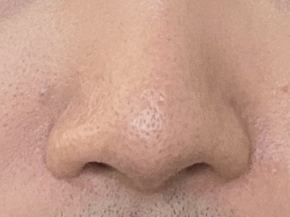 비공내리기 수술 만족하며 지내는 중입니다