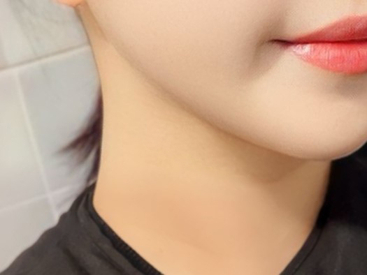 이중턱 지방흡입 하고 너무 만족해요 !