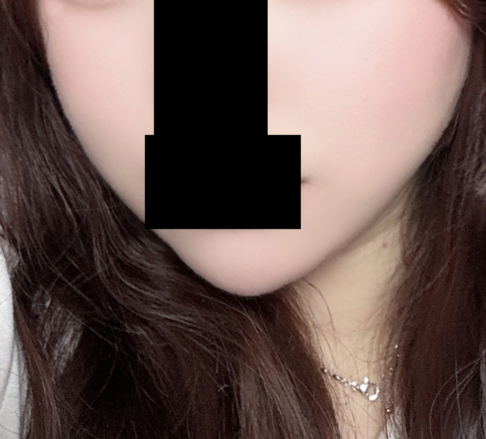 얼굴지방흡입 찐맛집!!