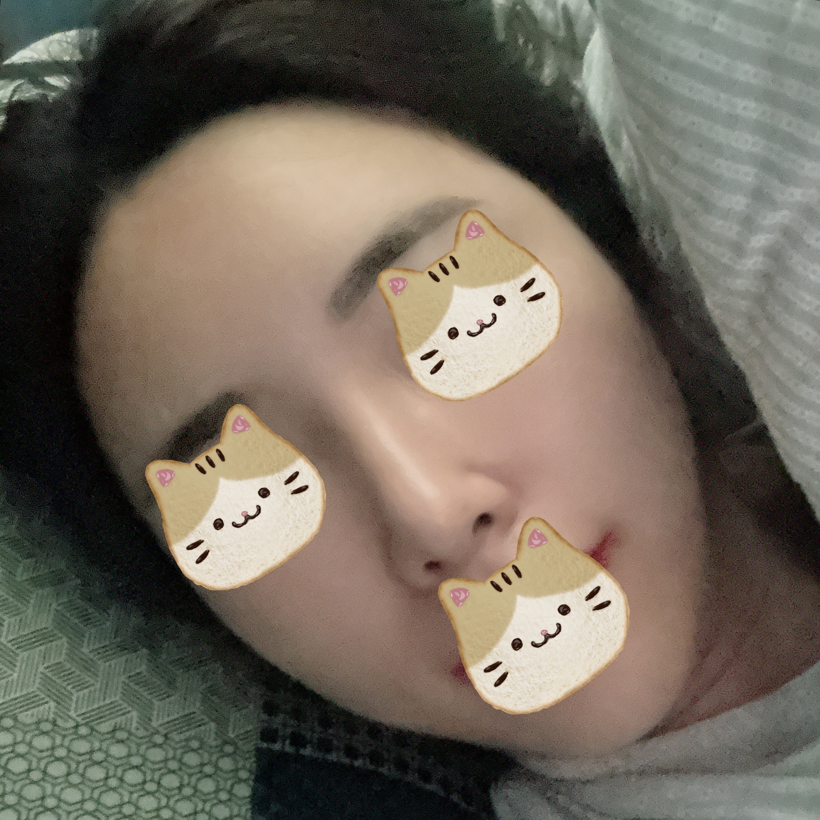 코 ,얼굴 지방이식 수술 3개월 됐어요