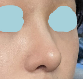 바이브에서 수술한지 반년지났어요~~