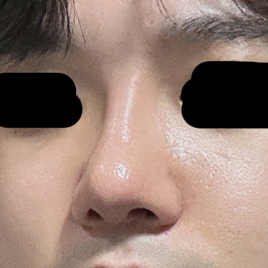 남자코수술 후기입니다.