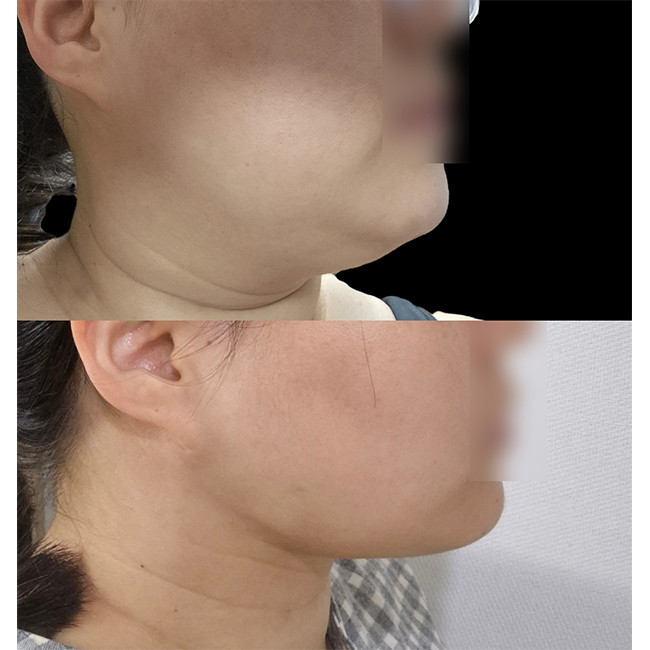 얼지흡+심부볼제거+슈링크 후기