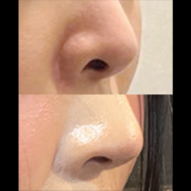 용코교정 재수술 후기>_<