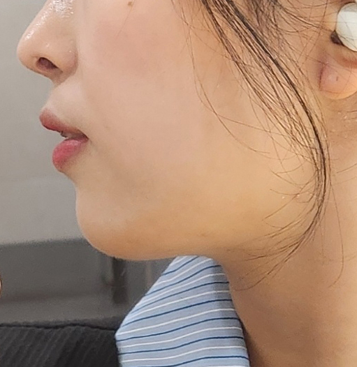 얼지흡후 얼굴라인 잘 정리됐어욥