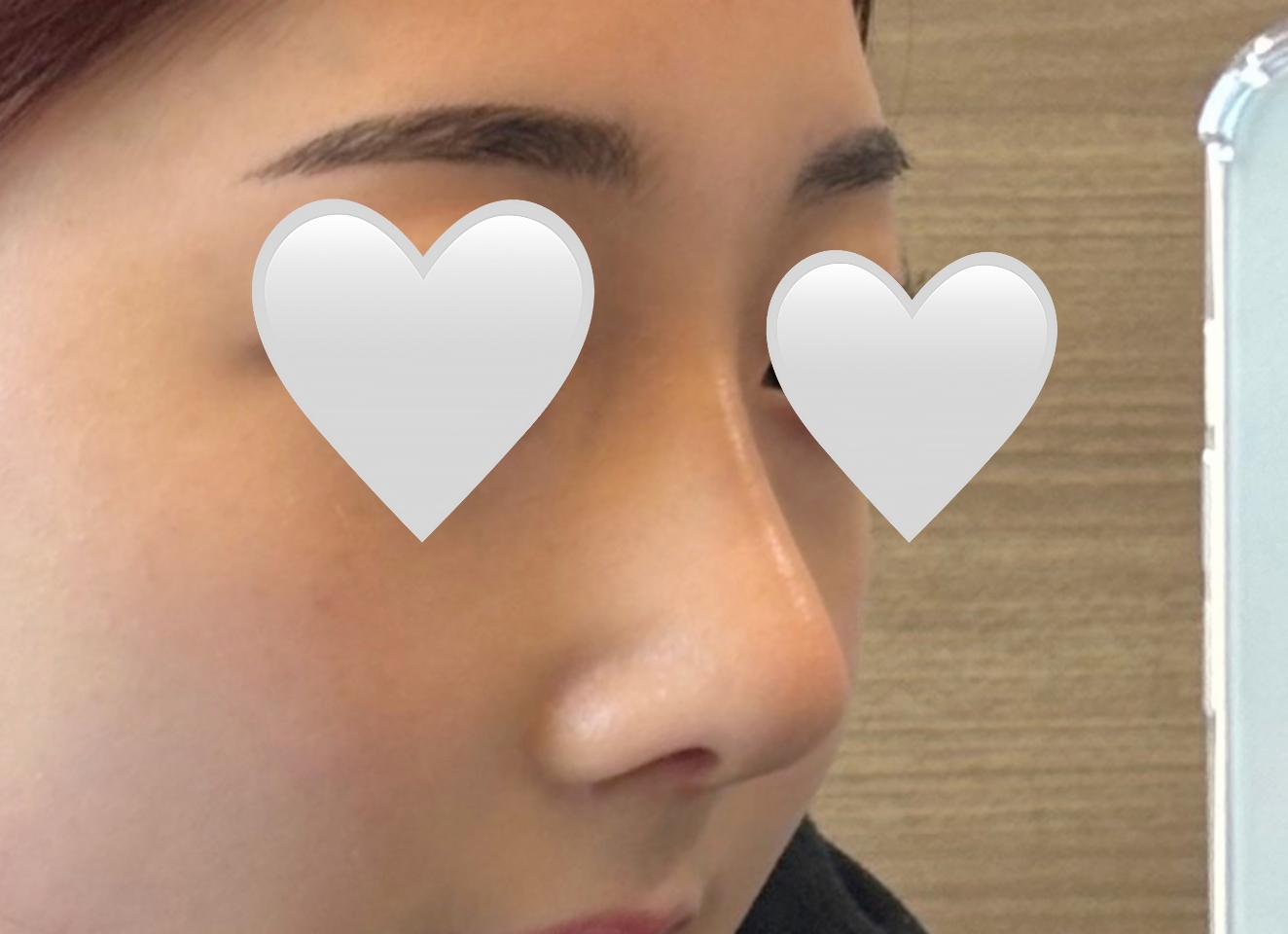 매부리 + 휜코 싹 잡혔어요!