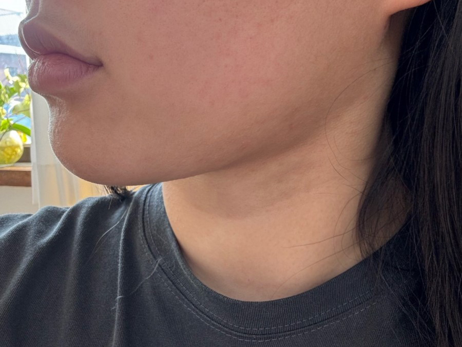 수술 후 확실히 갸름해져서 너무 만족 중입니다