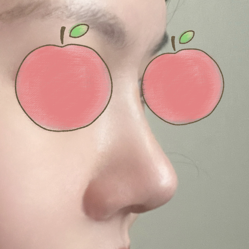 낮은코, 복코, 비순각 한달차에요 ㅎㅎ