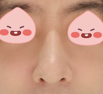 코수술 한달차! 모양 맘에 들어요