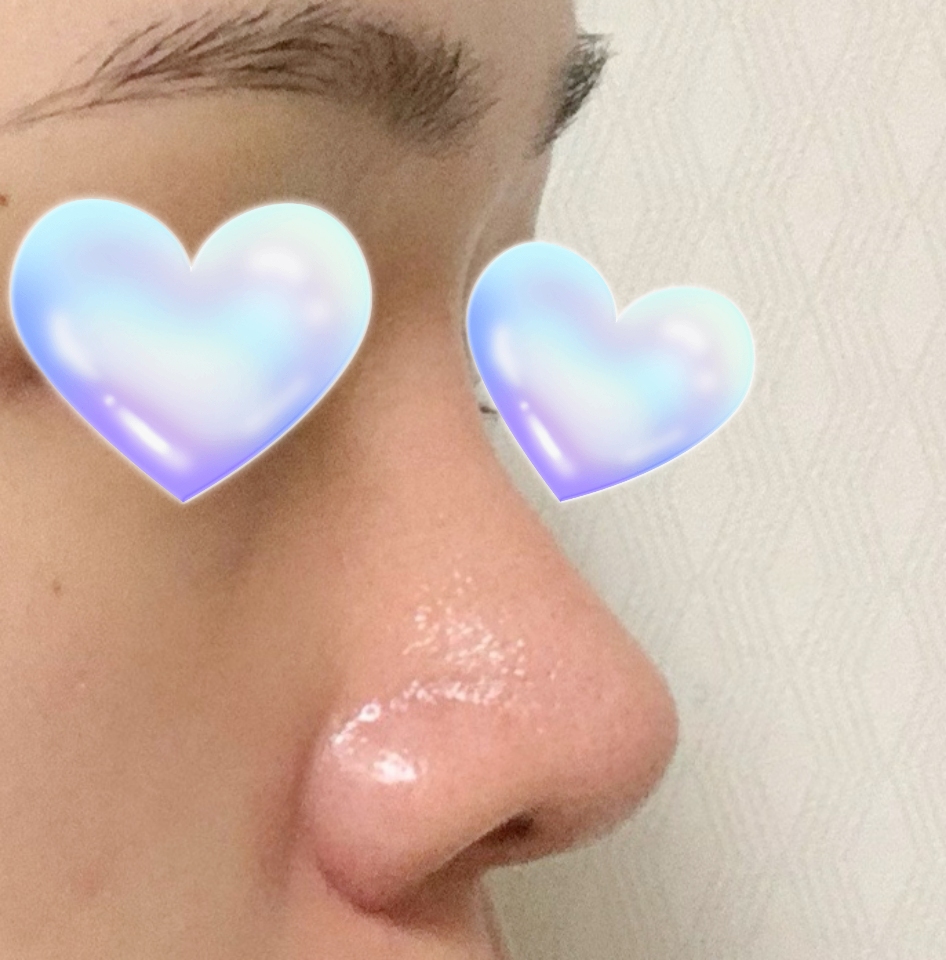 코성형6갤차! 매우 만족 ㅠㅠㅠㅠㅠ