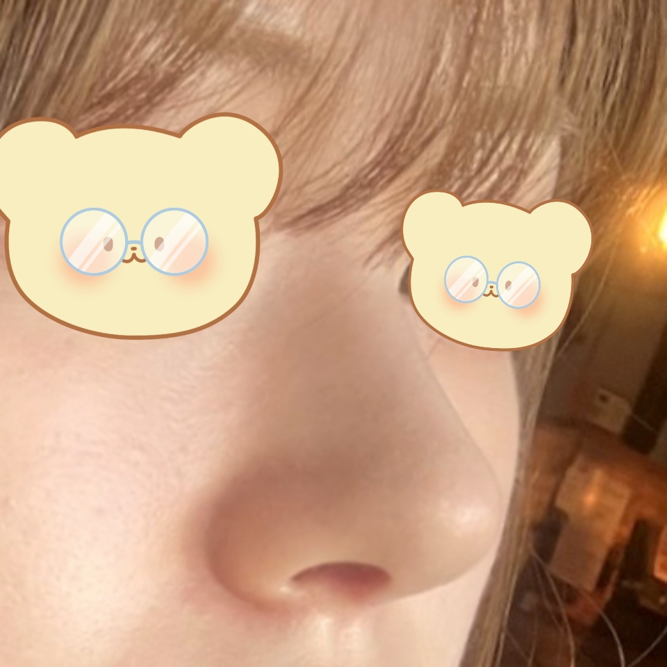 코수술 성공적입니다 너무 행복해요 ㅎㅎ