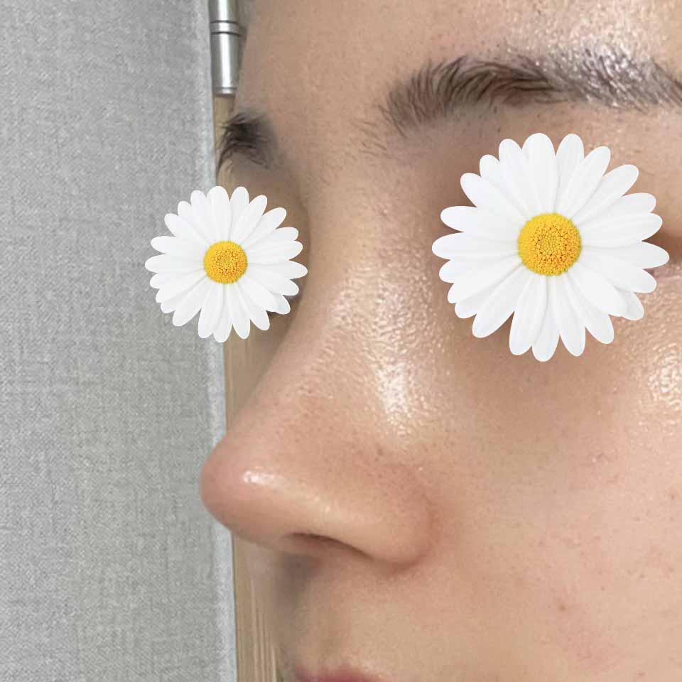 코재수술 정말 강추합니다