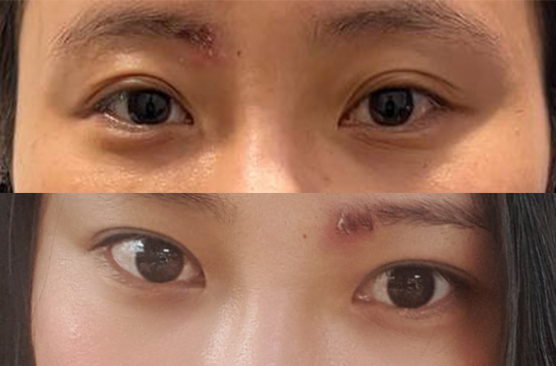 눈성형, 얼굴지흡 둘다 잘됐어요!