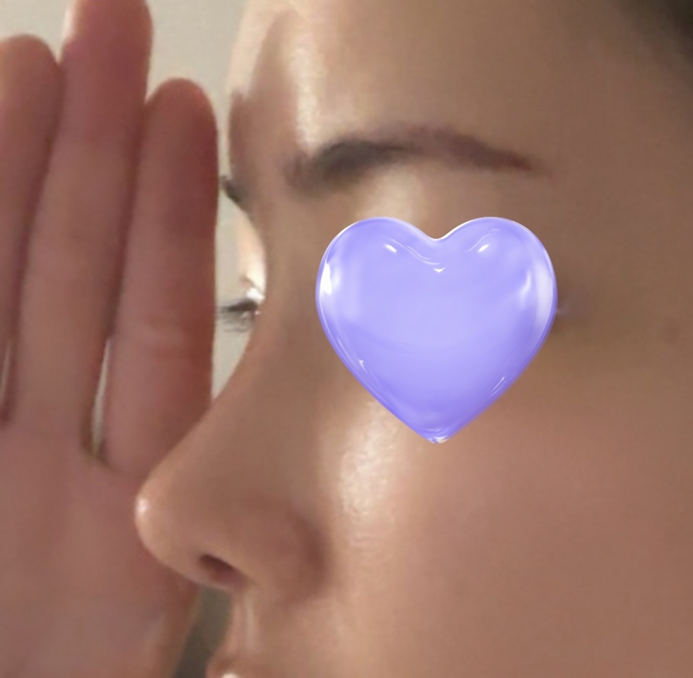 10년전 코하고 바이브에서 다시 재수술한 후기!