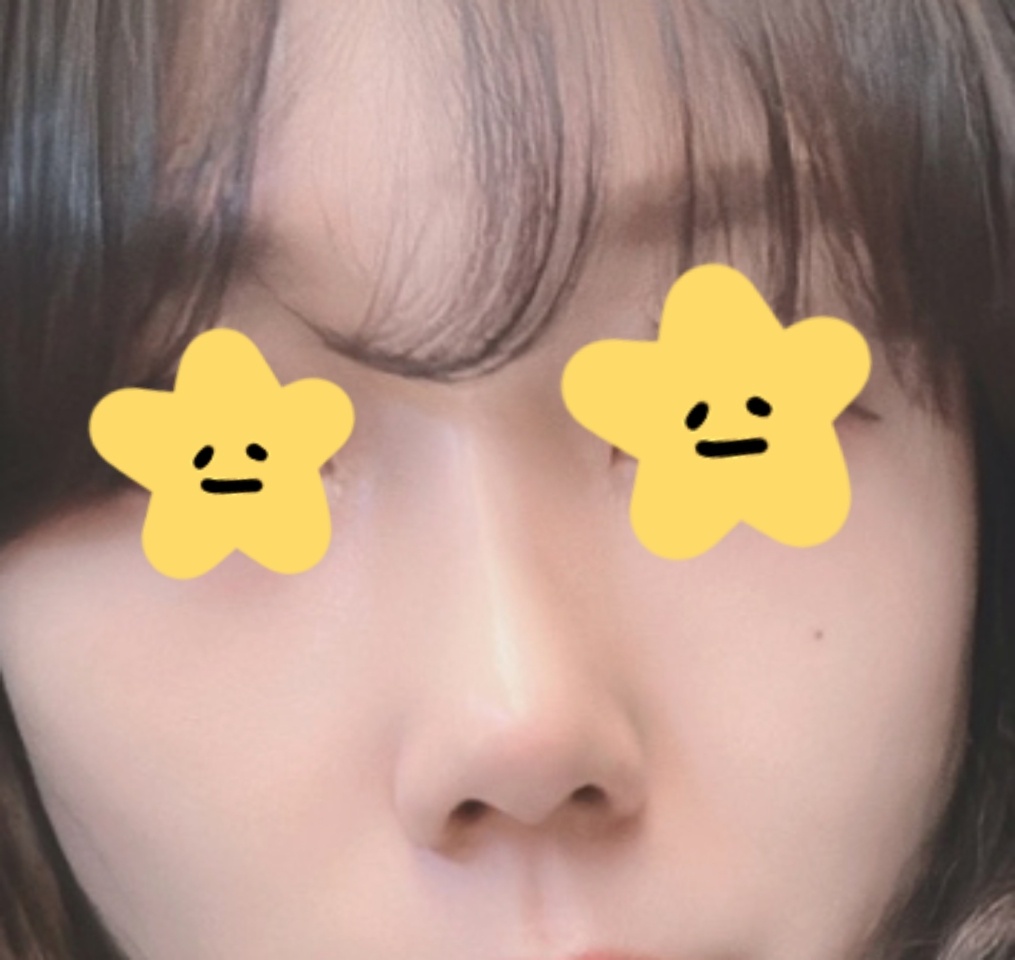 복코수술+눈밑지방재배치 했습니돠~!!