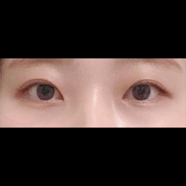 절개눈매교정수술 했습니다~