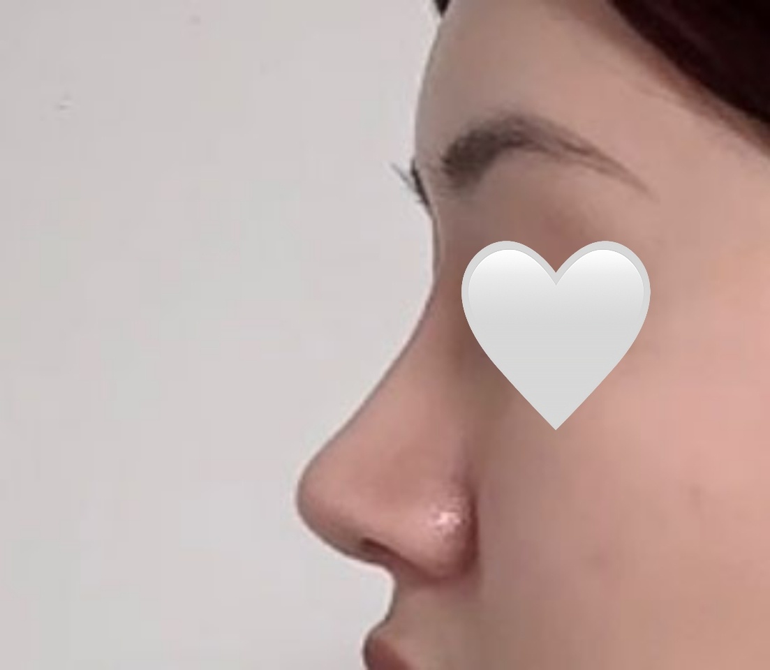 코, 얼지흡 3개월차인데 만족중!