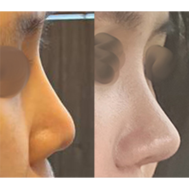 1._수술전후측면1.jpg