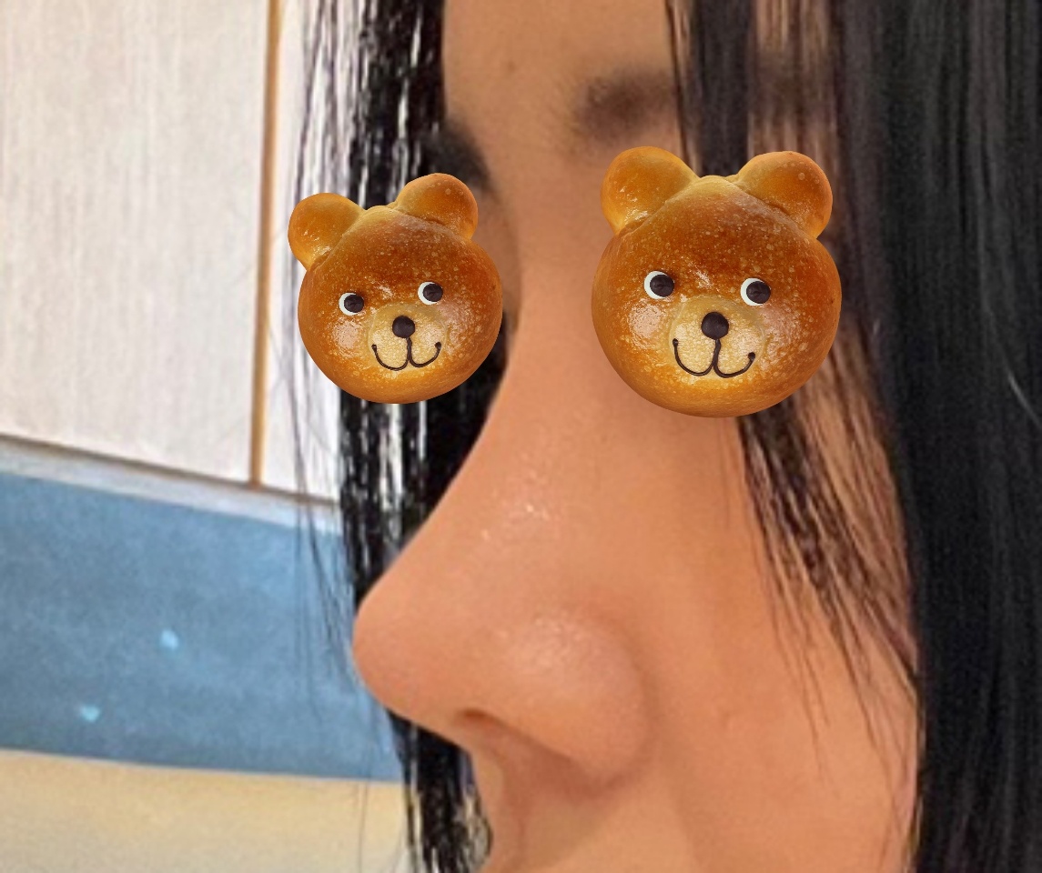 짧은 복코수술 후기에용!