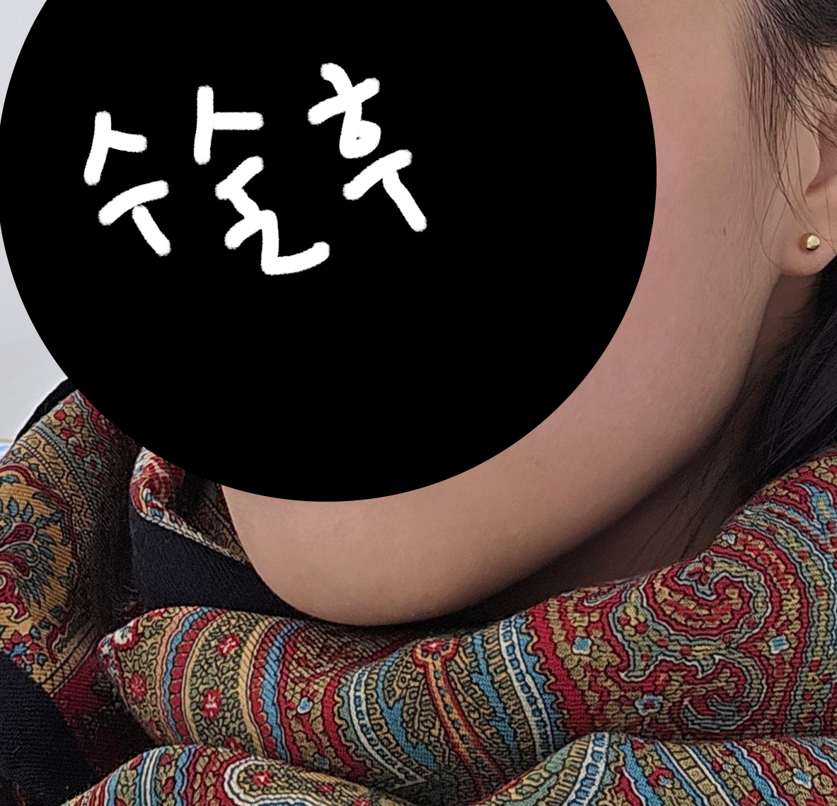 지방흡입으로 이중턱 빠이빠이했어욤