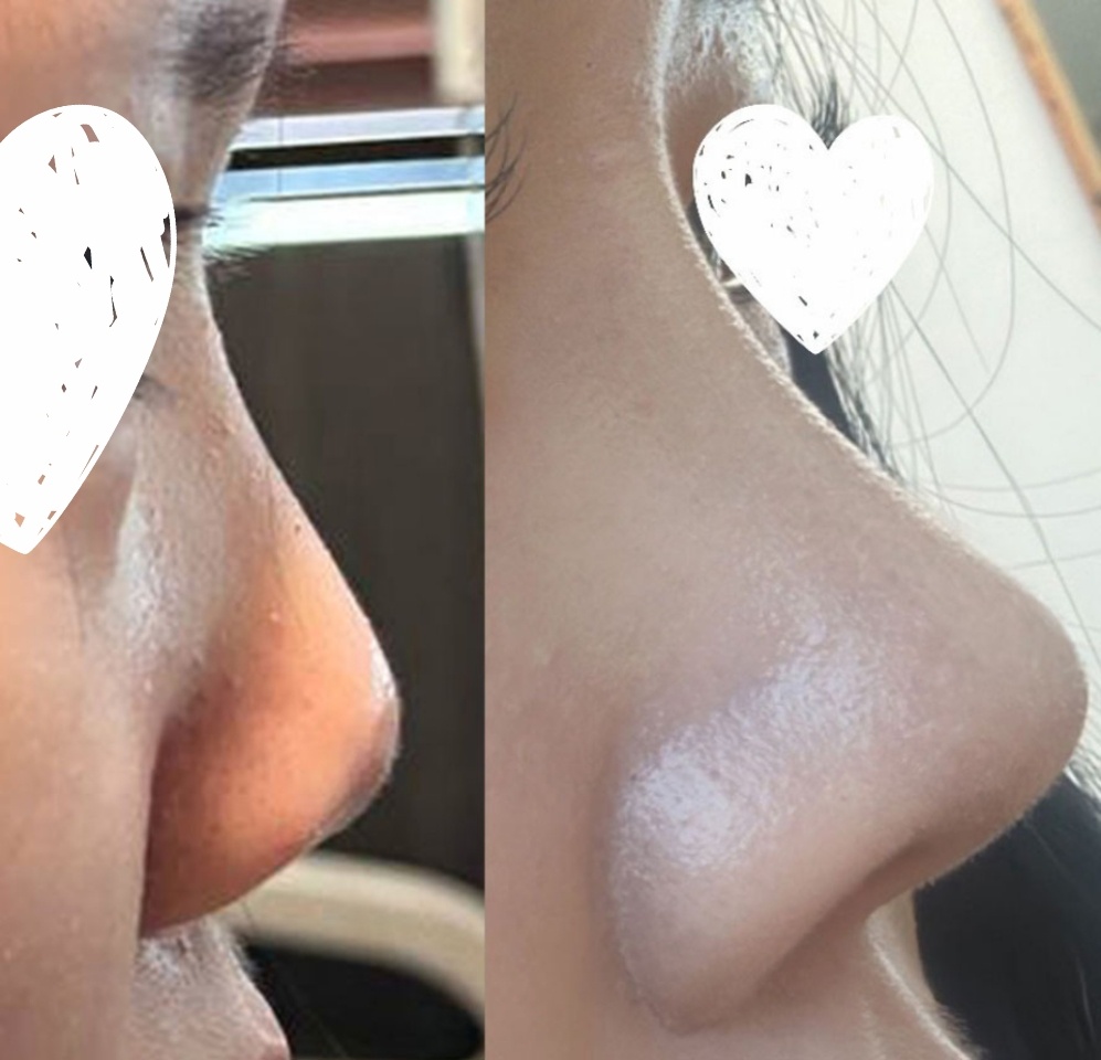 눈재수술, 첫코성형 7갤차 후기입니당