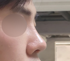 기능코성형후기올립니다.