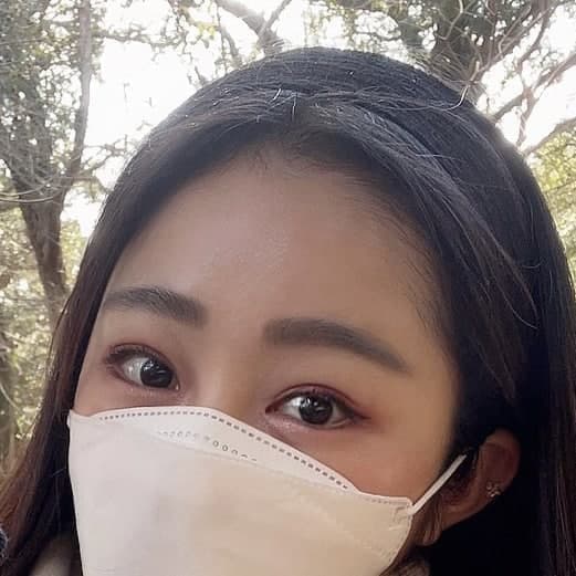 망고트임+내시경이마거상+눈재수술 후기입니당