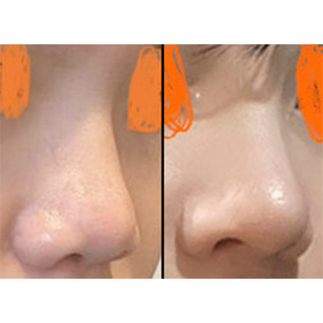 이제 복코, 짧은코 고민하지 않아요 ㅎㅎ