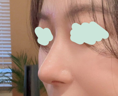 무보형물코성형 후기들고와쏘요><