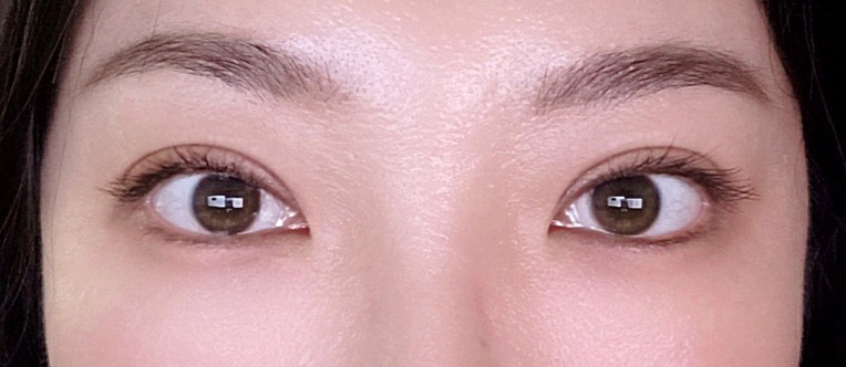 눈재수술 여기 믿고 가세요ㅎㅎ