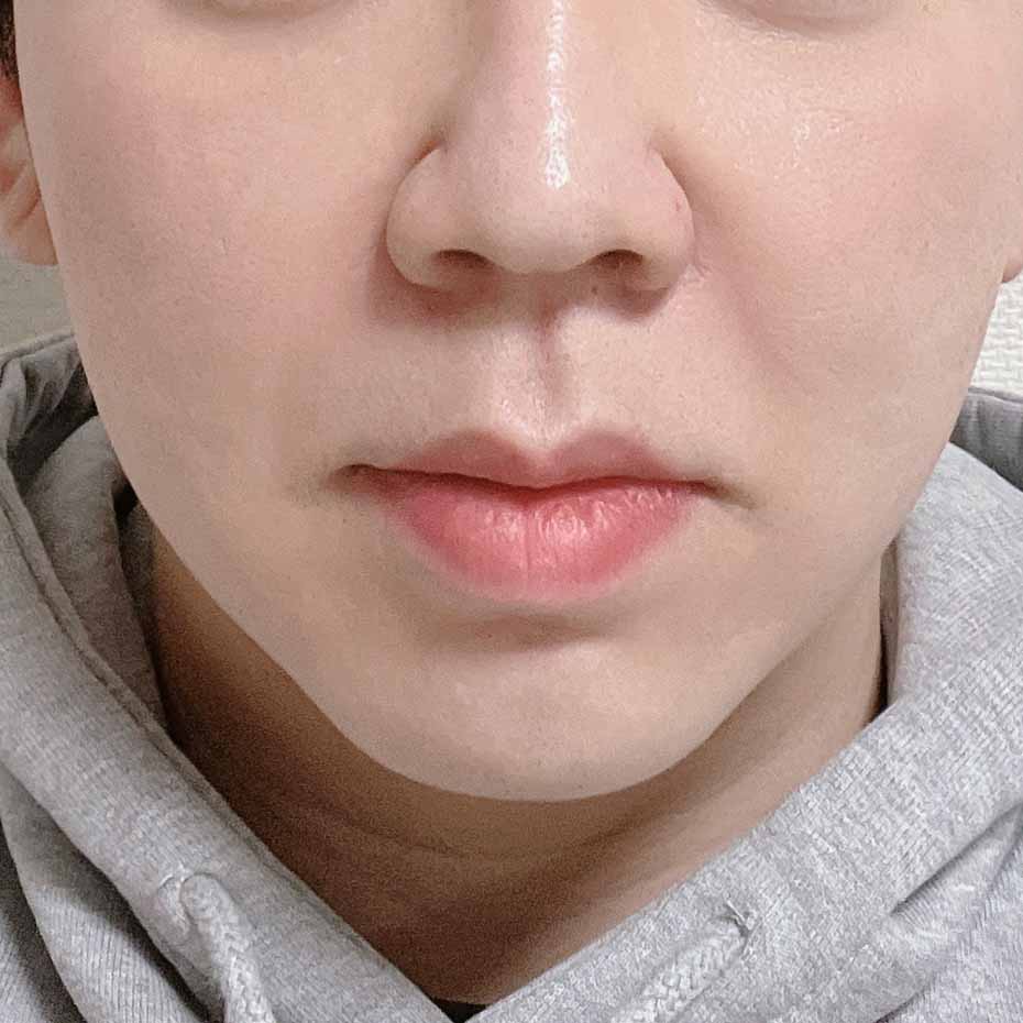 얼굴지방흡입+실리프팅+동안주사 후기!