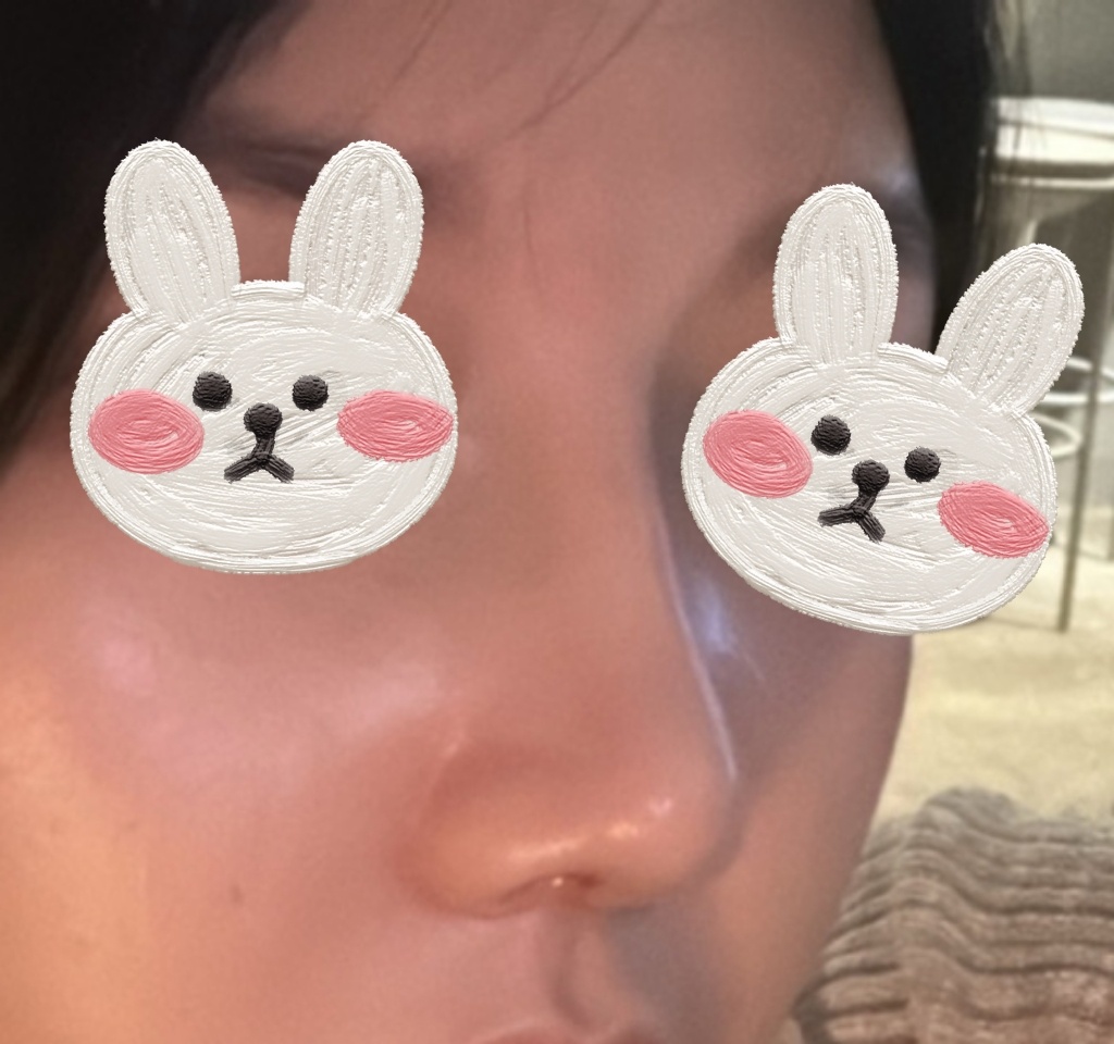 완전만족하구있어요!!코수술만족 100%이상!