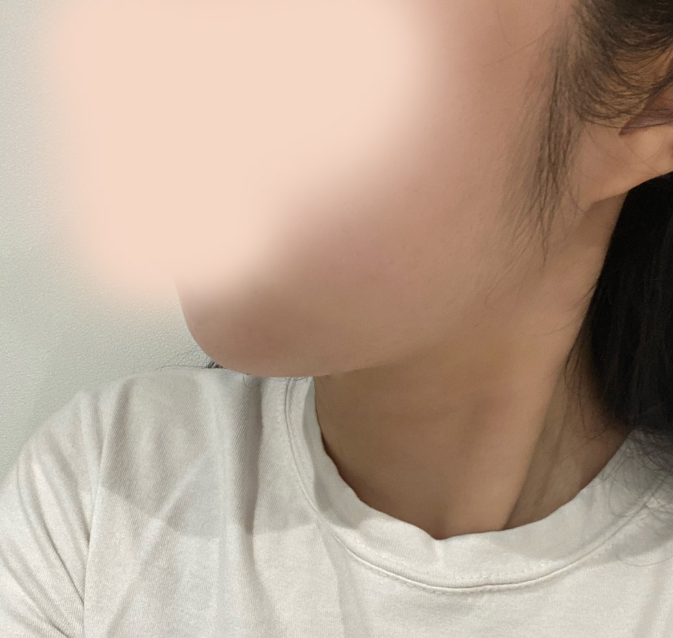 얼지흡! 후회없는 수술이에요 ㅎㅎ