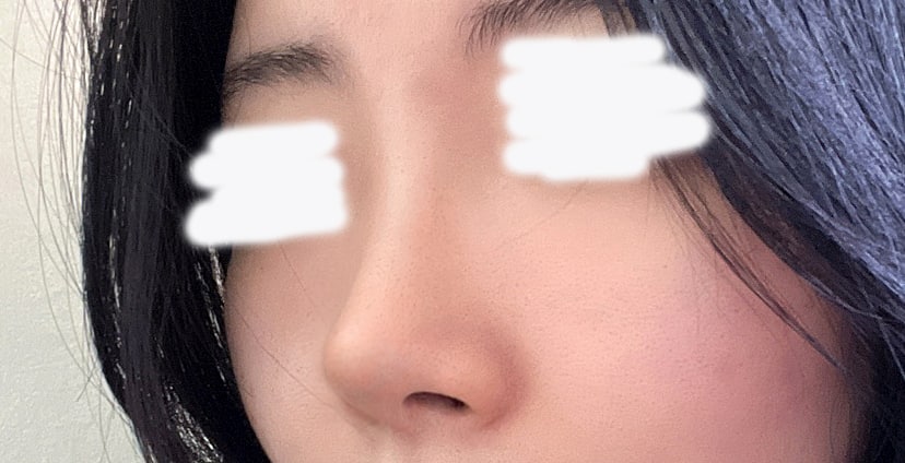 무보형물 코 수술 2주차에요