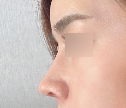 매부리코성형 6개월차^^