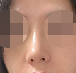 복코수술 정말 잘됐어요!유원장님 최공~~